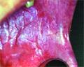 Új lehetőségek a szájüregi daganatok területén